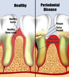 Gum Disease and Your Health